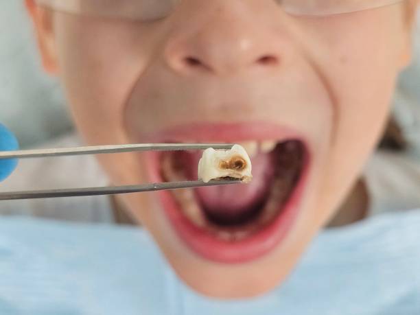 Best Dental Abscess Treatment in Highpoint, OH